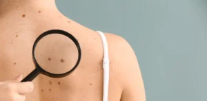 We don’t all need regular skin cancer screening – but you can know your risk and check yourself